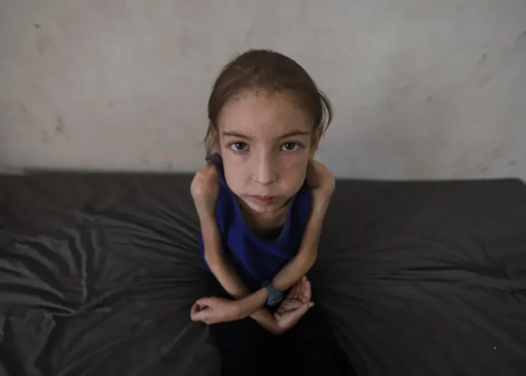 gaza malnourished girl